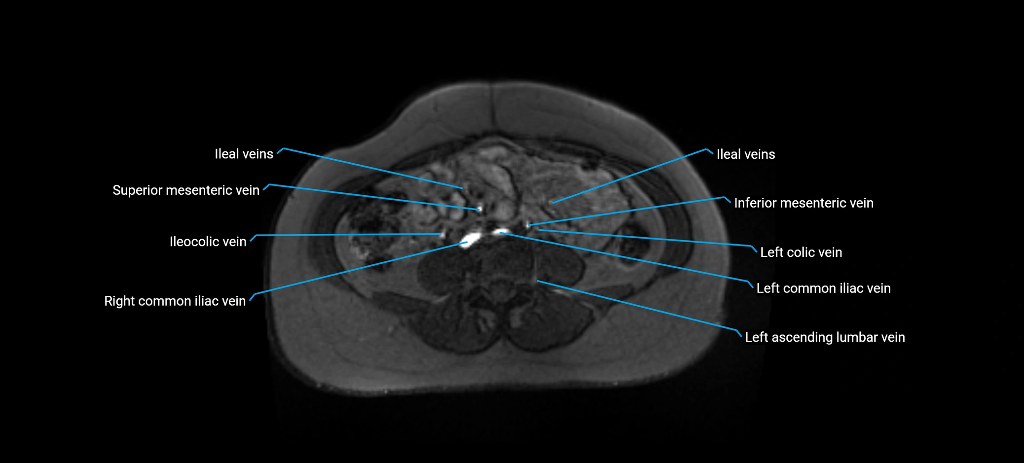 MRV abdomen pelvis & lower limb axial cross sectional anatomy labelled MRI image 112 (1).webp